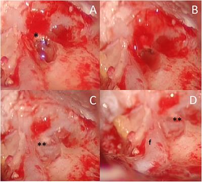 Labyrinthine Fistula in Cholesteatoma Patients: Outcomes of Partial Labyrinthectomy With “Underwater Technique” to Preserve Hearing